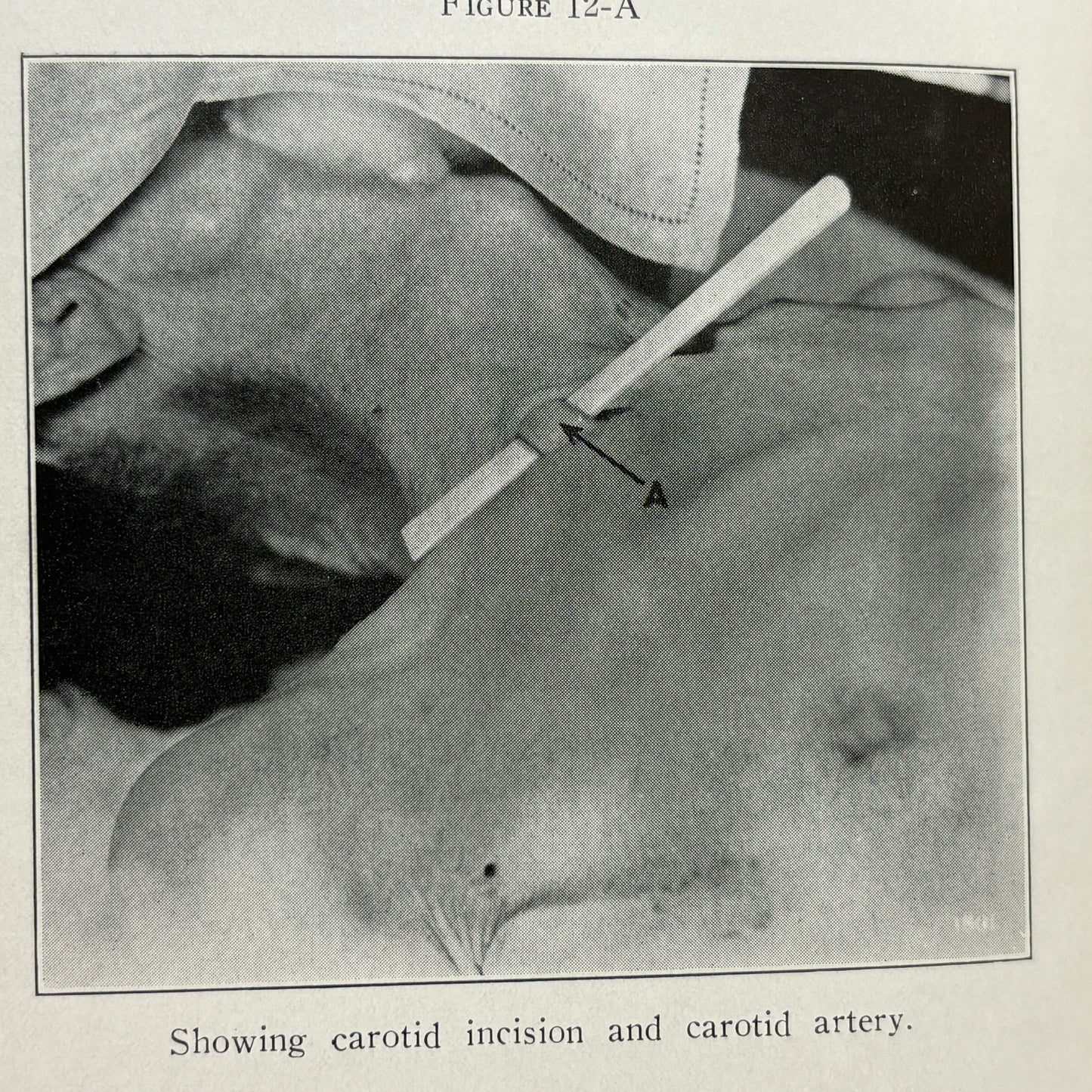 SPRIGGS, A. O. "Champion Textbook on Embalming" [The Champion Co, 1933]