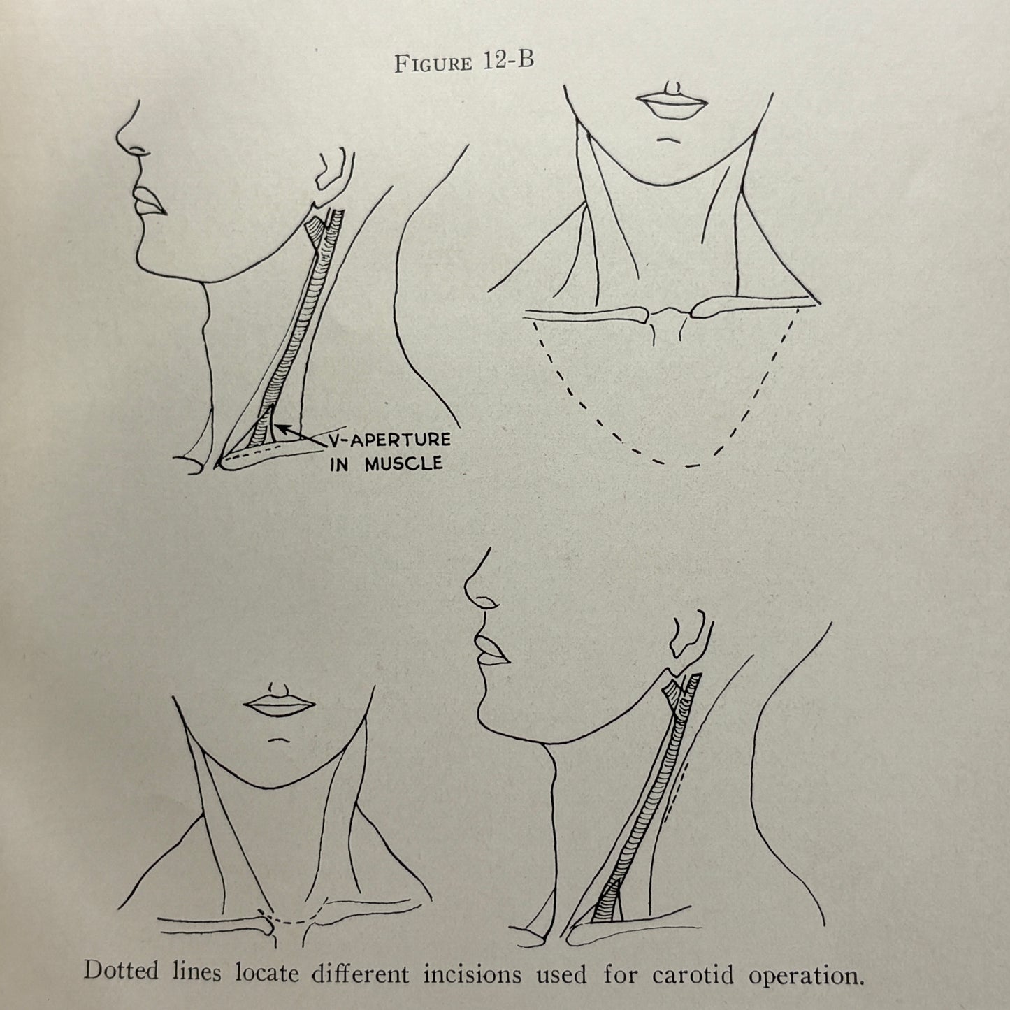SPRIGGS, A. O. "Champion Textbook on Embalming" [The Champion Co, 1933]