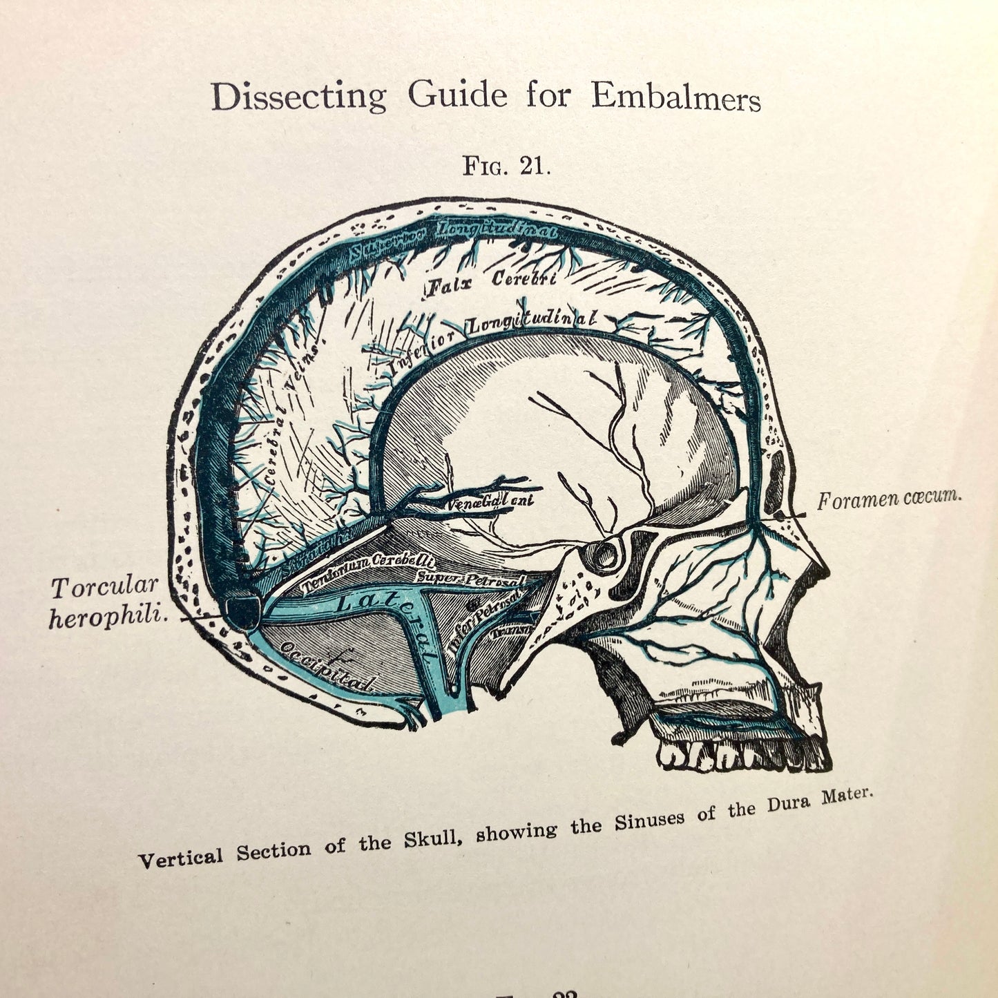 DHONAU, Charles O. "Dissecting Guide for Embalmers" [The Embalming Book Co, 1931]